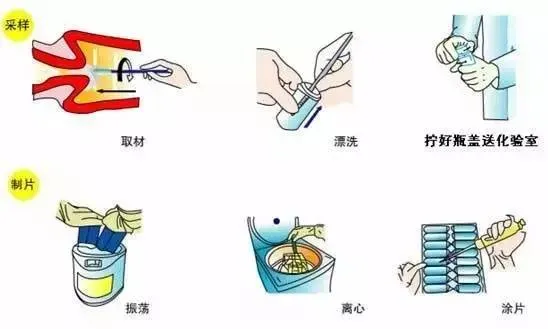 试管前期女性检查知多少-TCT检查