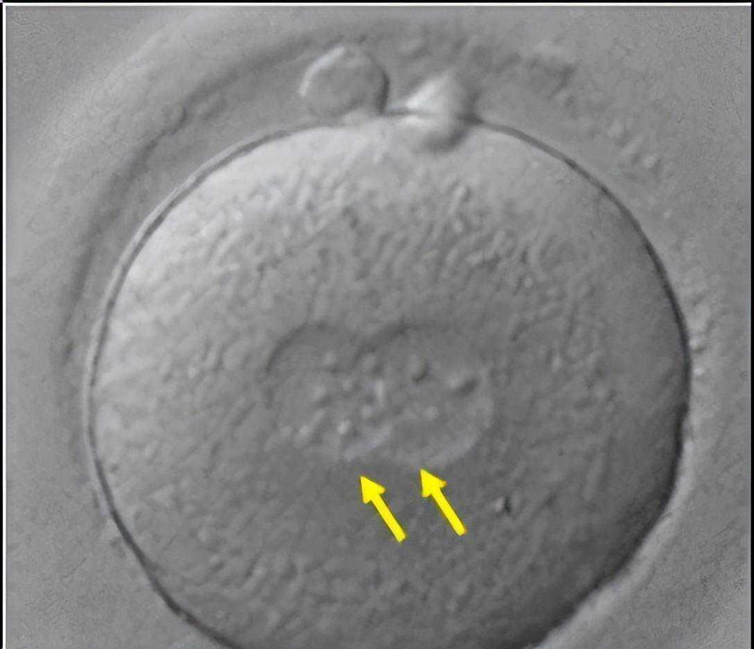 3分钟教你看懂试管婴儿囊胚报告
