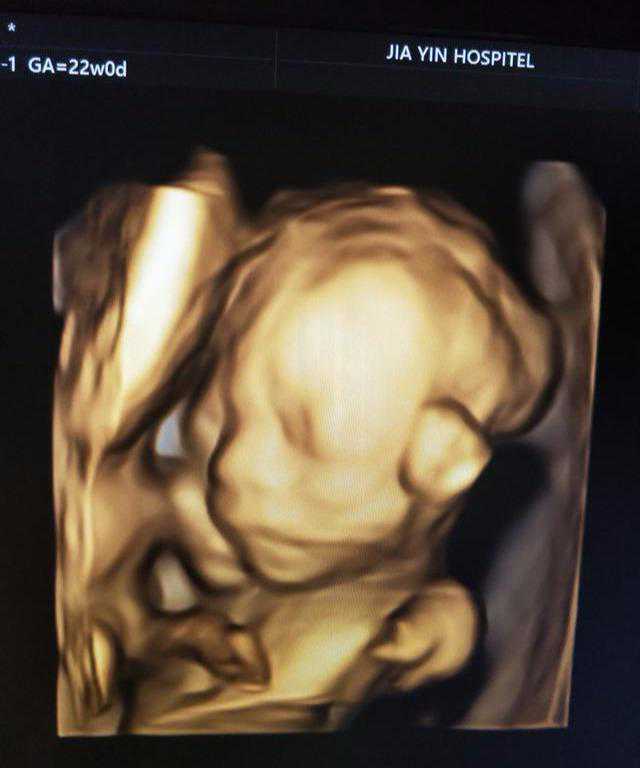 双胞胎试管婴儿受孕成功后的孕期分享（三）