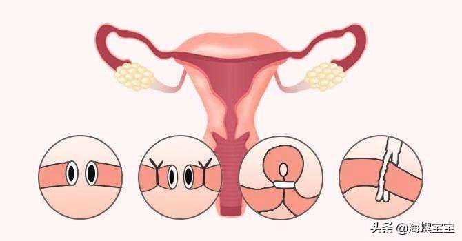 做试管还要处理输卵管问题？移植后要如何避免宫外孕？