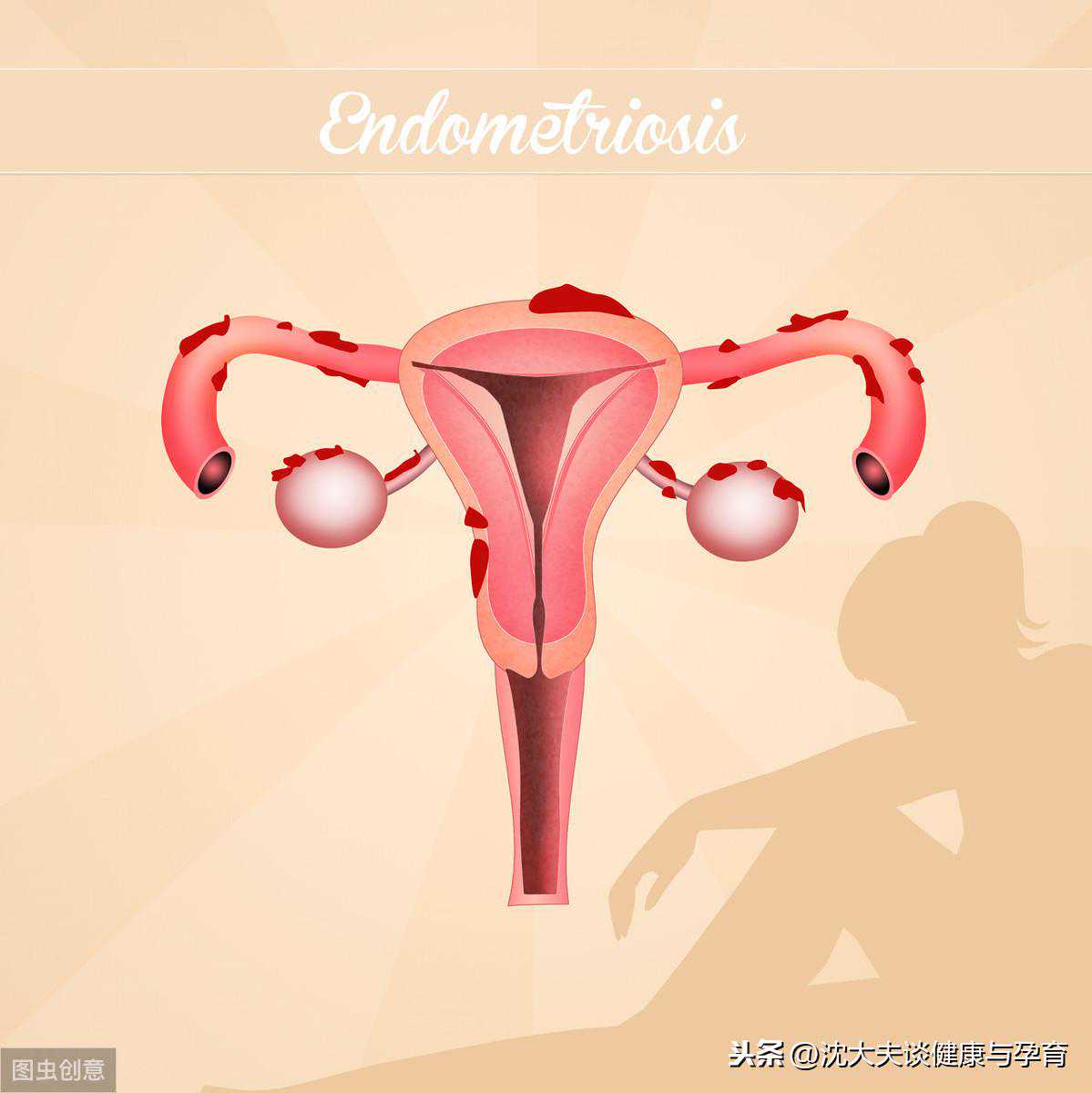 子宫内膜异位性不孕，手术试管均失败，中医调理一月怀上