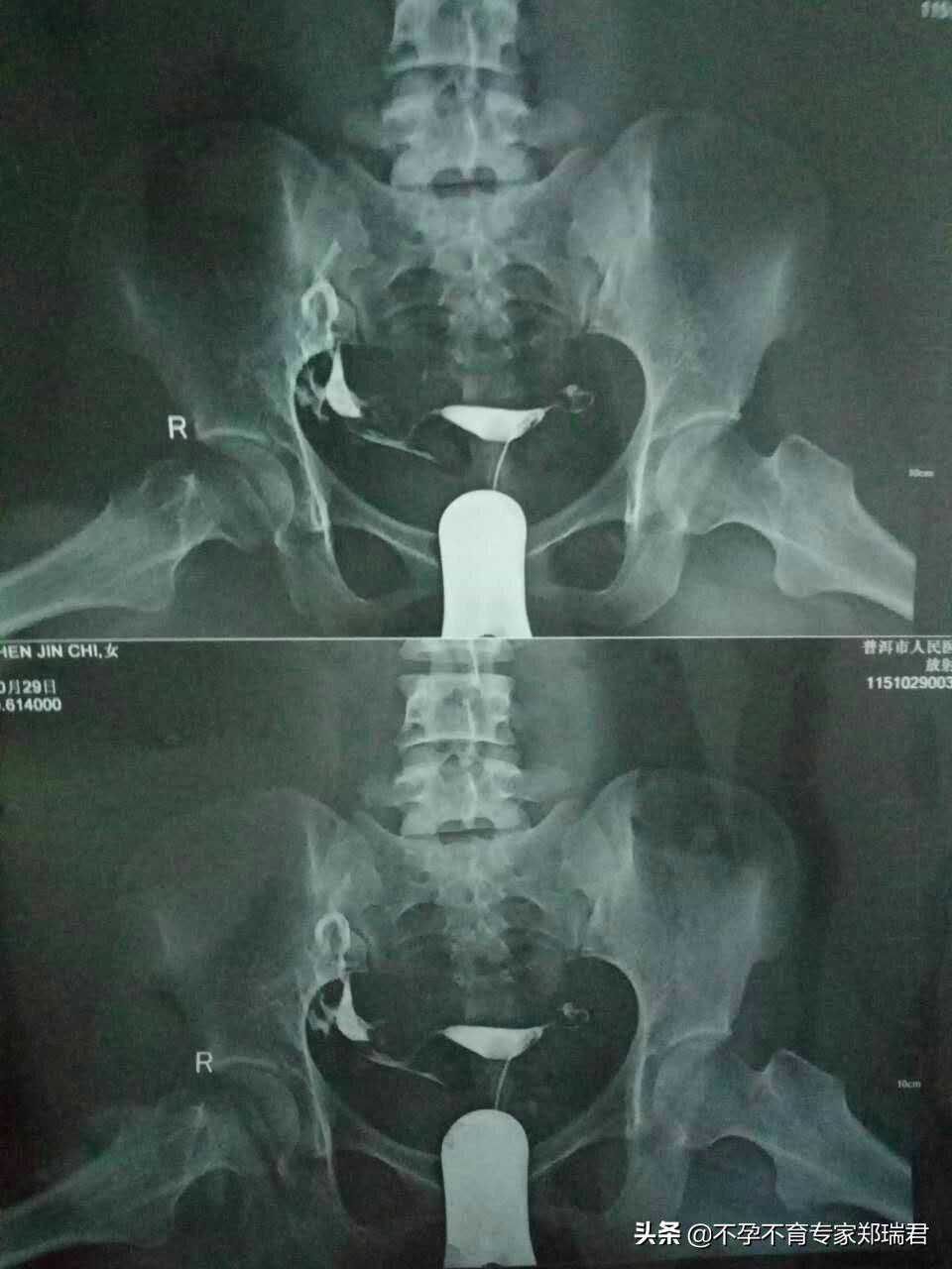 输卵管梗阻6年不孕，导丝试管均失败，小姑子让我怀上了